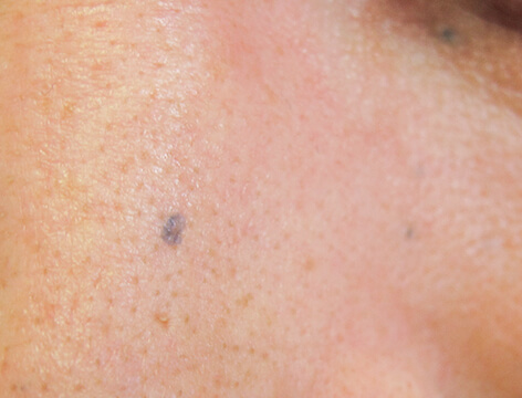 Blue birthmark