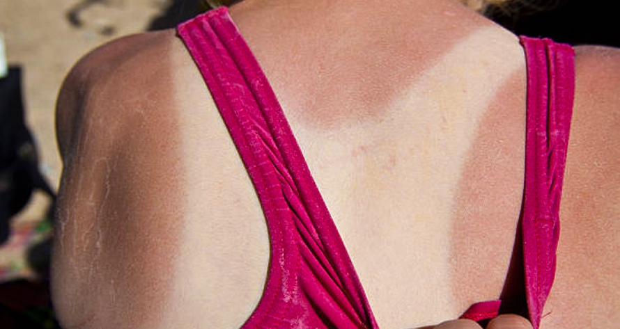 Photosensitivity – sunburn caused by chemicals